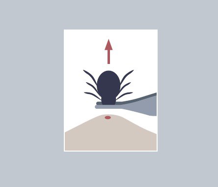 Extracción de garrapata. Extracció de paparra Extracción de garrapata. Extracció de paparra